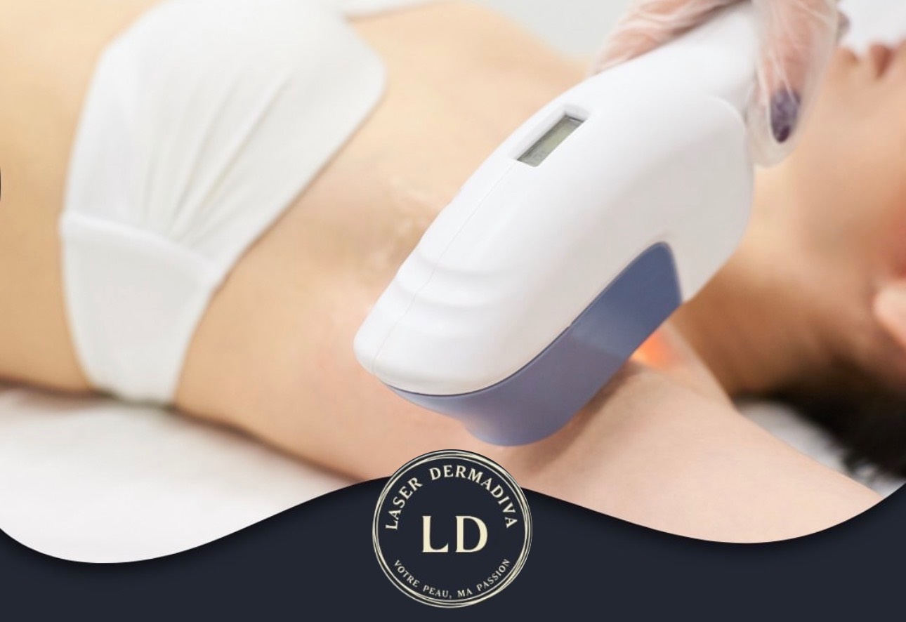 Épilation au laser